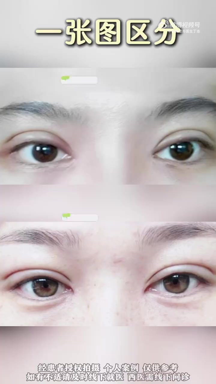 一张图帮你区分,肉条感&水肿感 丁志医生 割双眼皮 全切双眼皮 医学科普