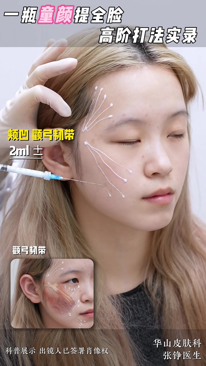 一支肉毒,全脸提升|点位用量