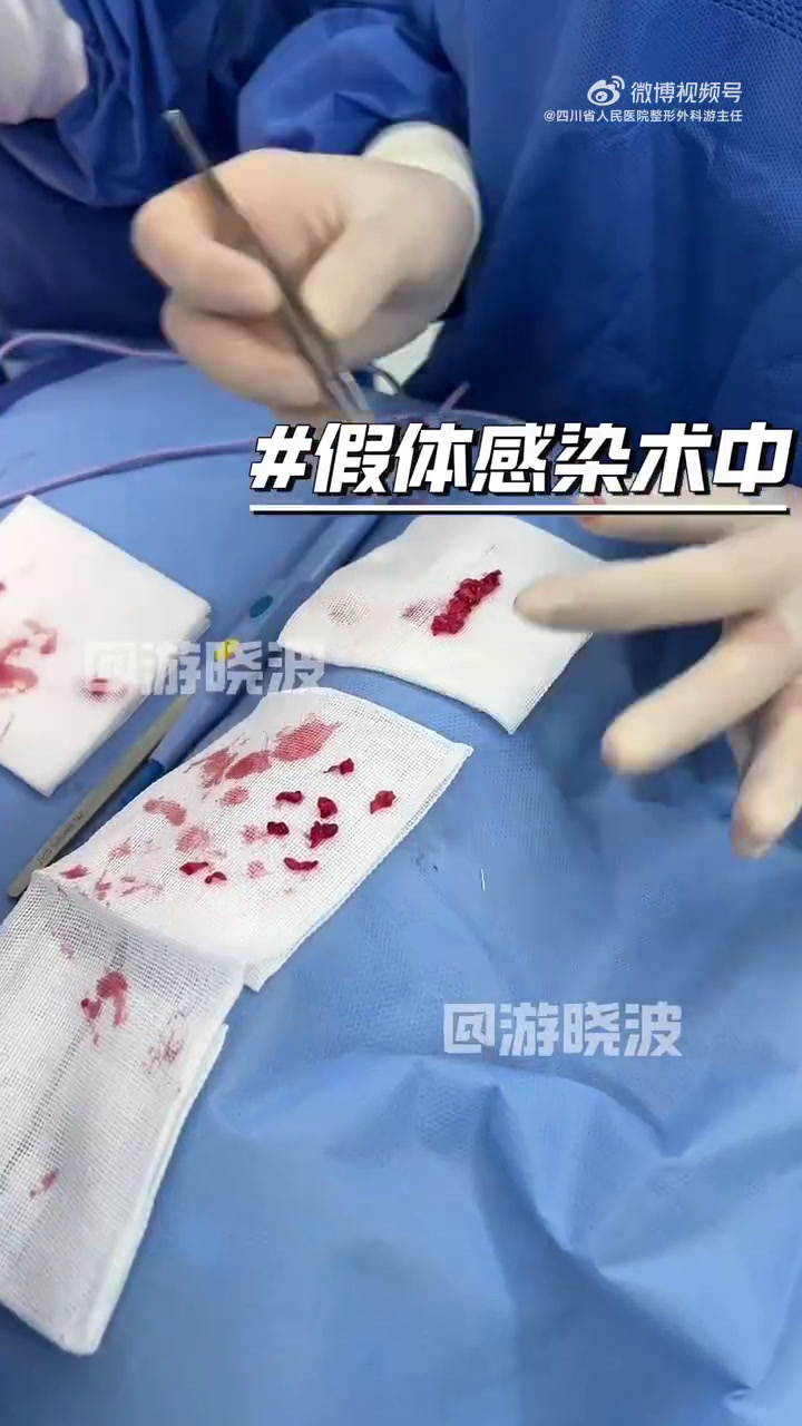 视频中是一台假体感染术中,从鼻腔内取出的肉芽肿。一般假体感染后,可能会由于局部感染等刺激鼻