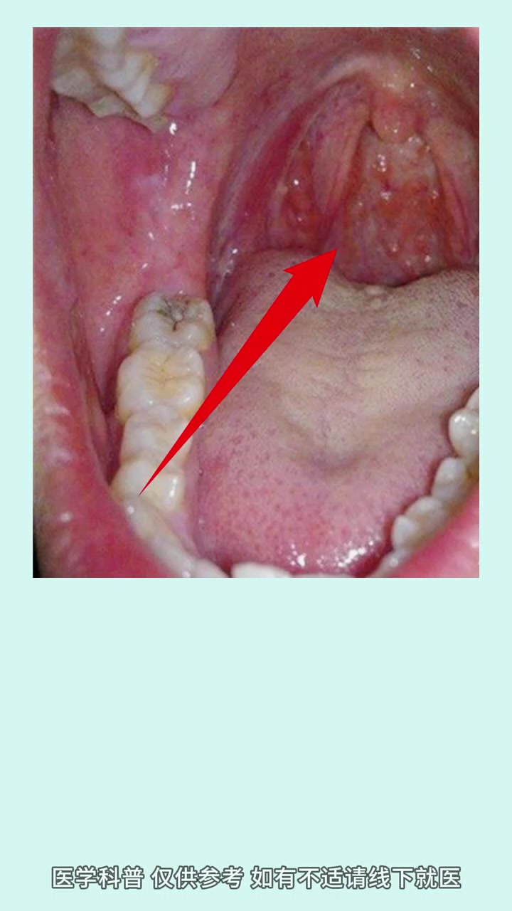 舌根淋巴滤泡增生看这条视频就够了 中医