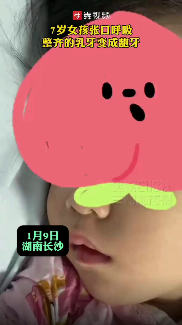 7岁女孩张口呼吸,整齐的乳牙变成龅牙