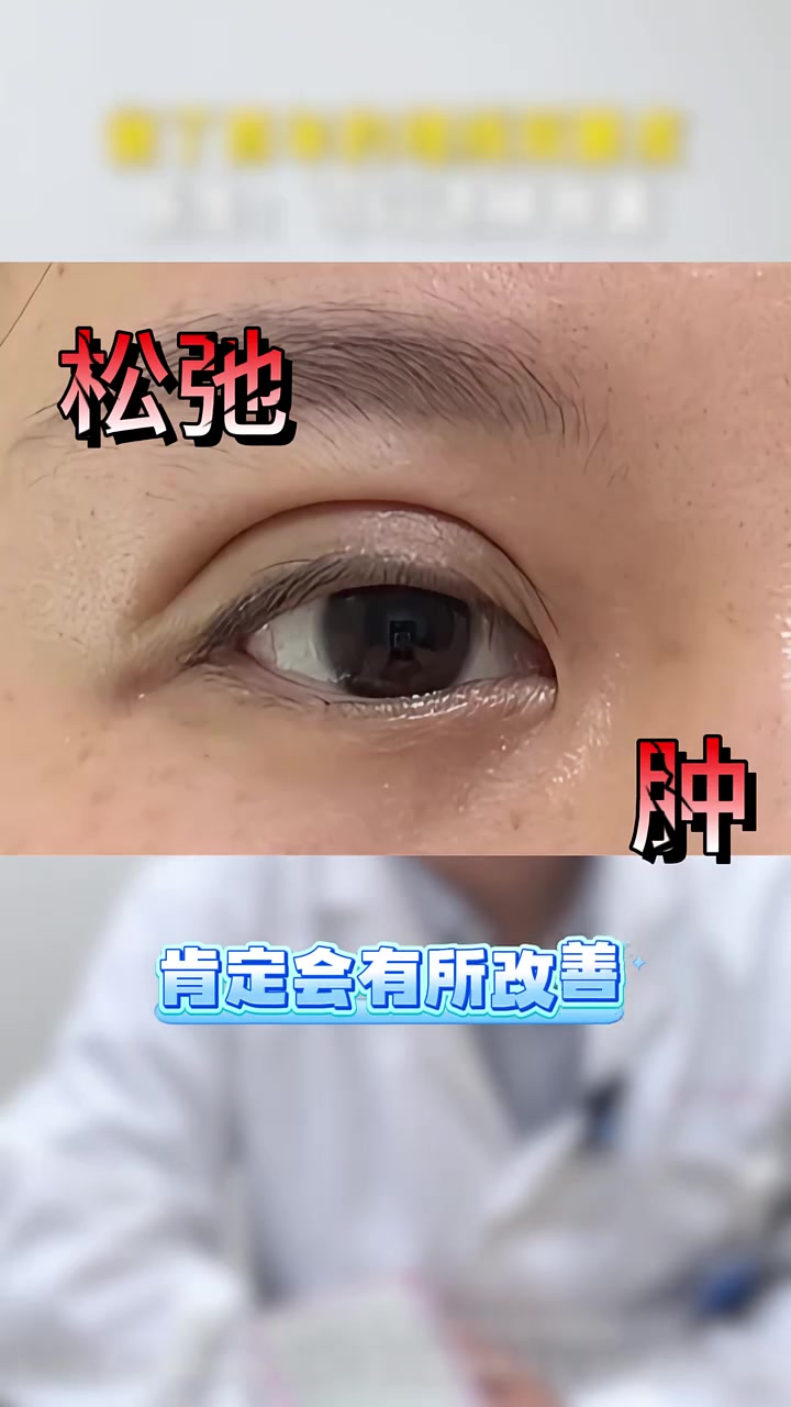 做了四年埋线的肿眼泡 医生:可以这样改善 双平面提升 双眼皮修复