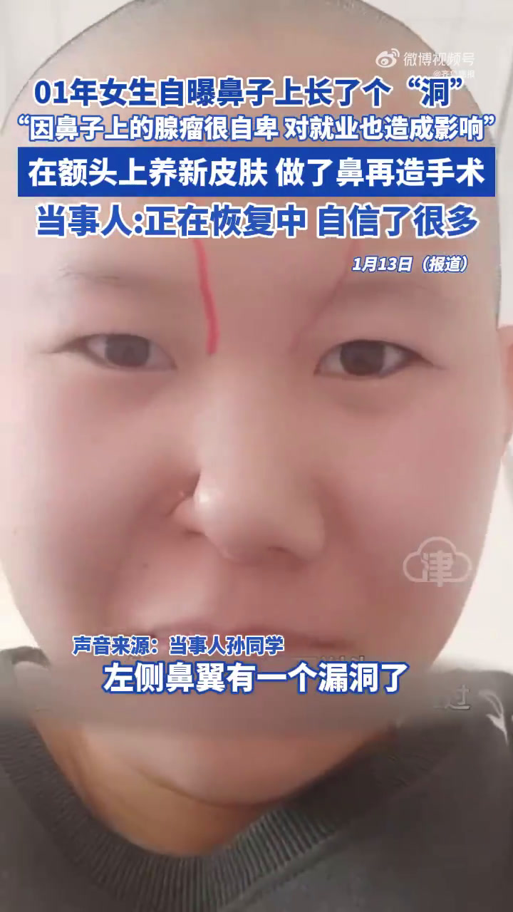 1月13日(报道时间)。当事人孙同学称,自己鼻子里长了个腺瘤,左侧鼻翼有一个漏洞了,感觉很