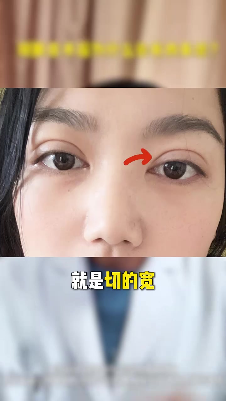 双眼皮术后为什么会有肉条感?双平面提升 双眼皮修复