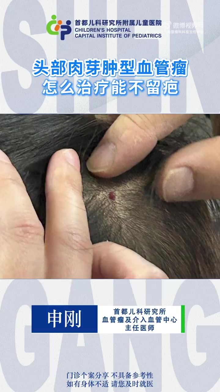 头部肉芽肿型血管瘤 怎么治疗能不留疤