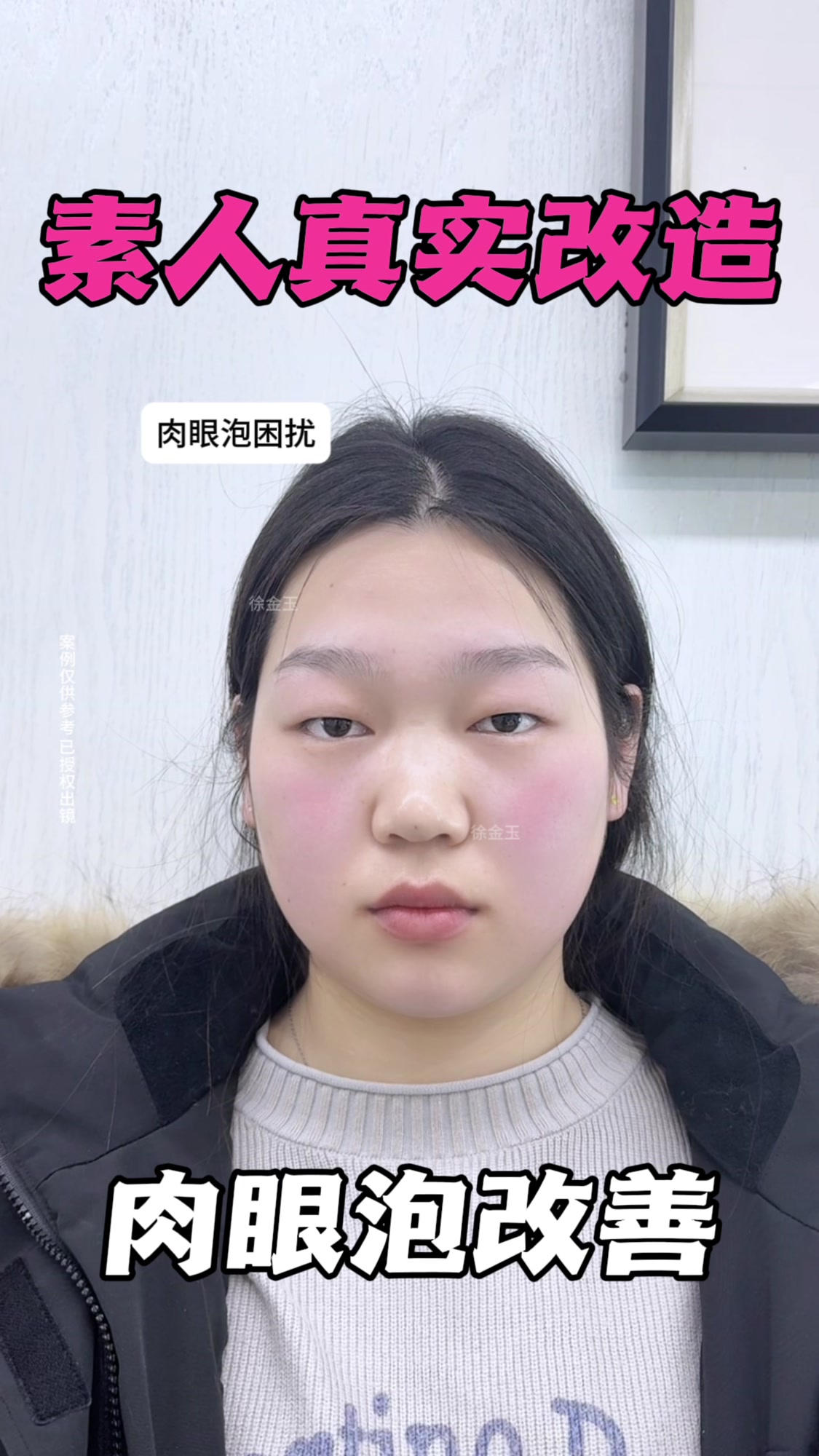 肉眼泡如何改善轻薄大眼