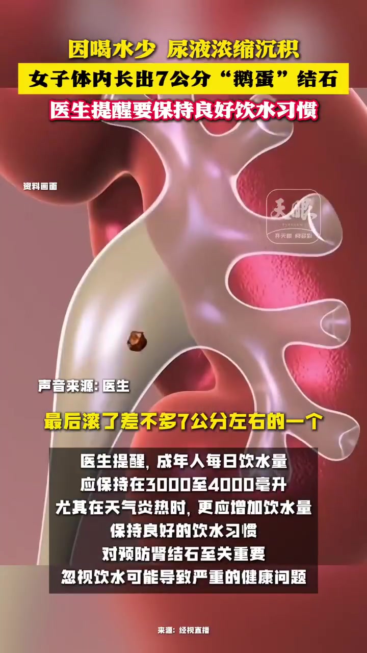 近期,湖北的吴女士因腰部剧痛难忍前往医院,本以为是小毛病,结果医生在她体内发现了一个酷似鹅