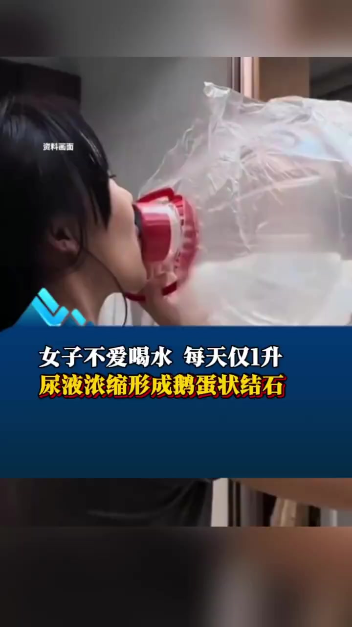 女子不爱喝水 每天仅1升 尿液浓缩形成鹅蛋状结石