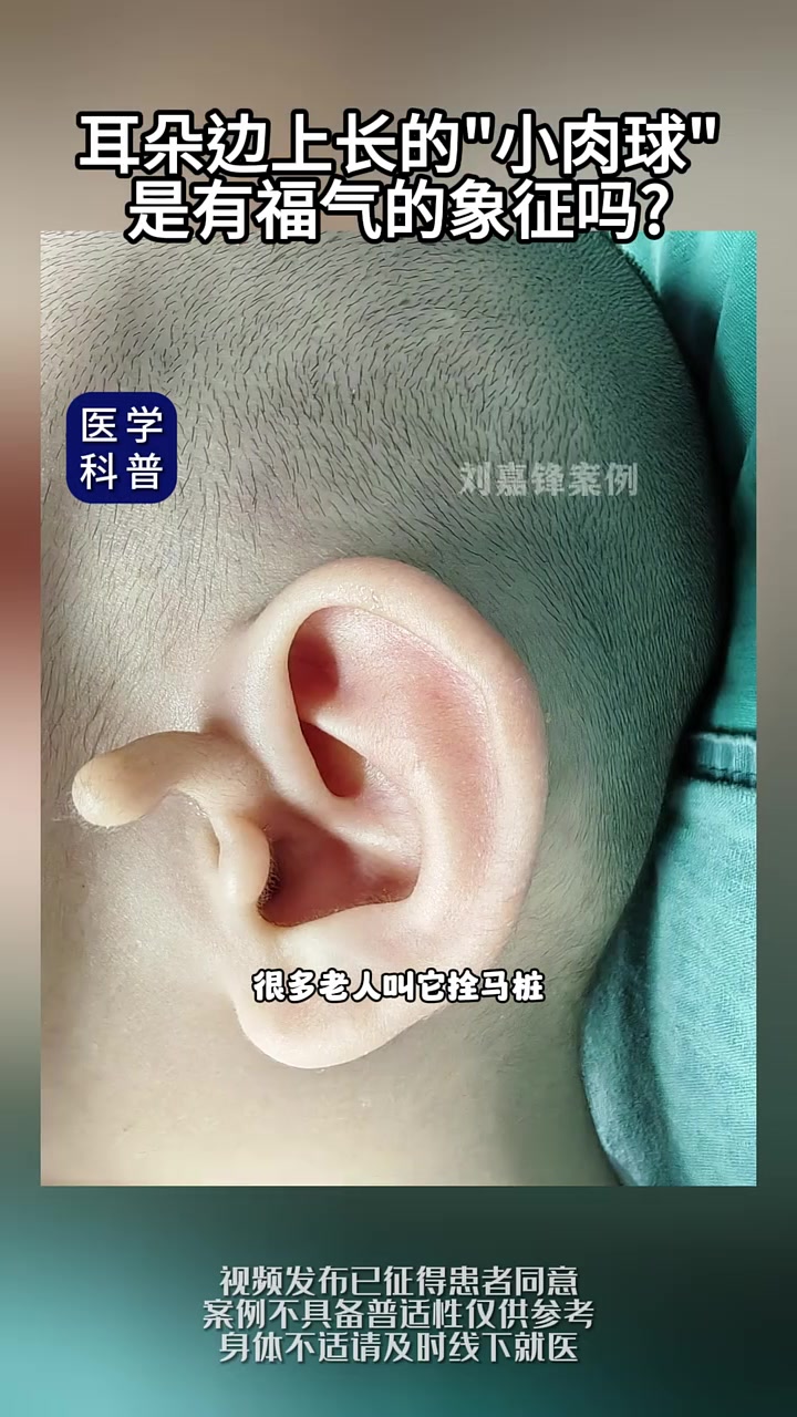耳朵边上长的“小肉球”是有福气的象征吗?该不该切除?附耳 刘嘉锋耳再造