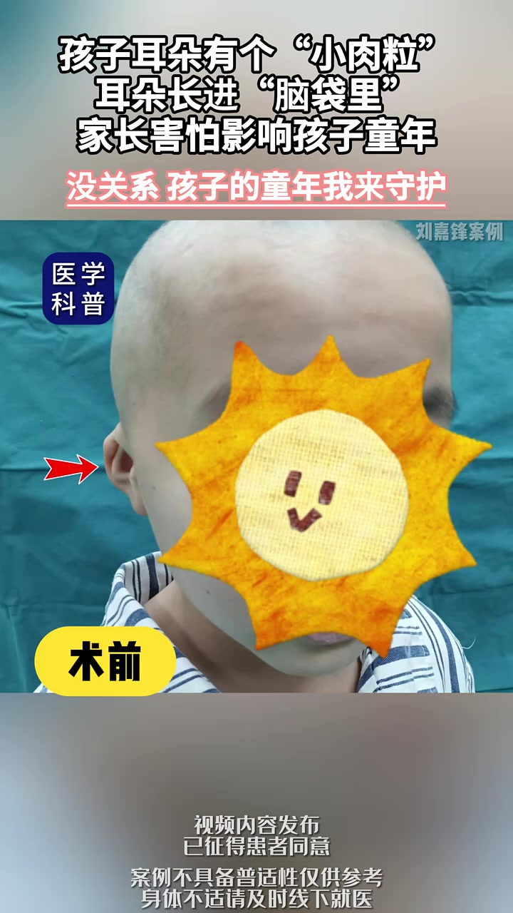 孩子耳朵有个“小肉粒“,耳朵长进“脑袋里,家长害怕影响孩子童年。隐耳 附耳