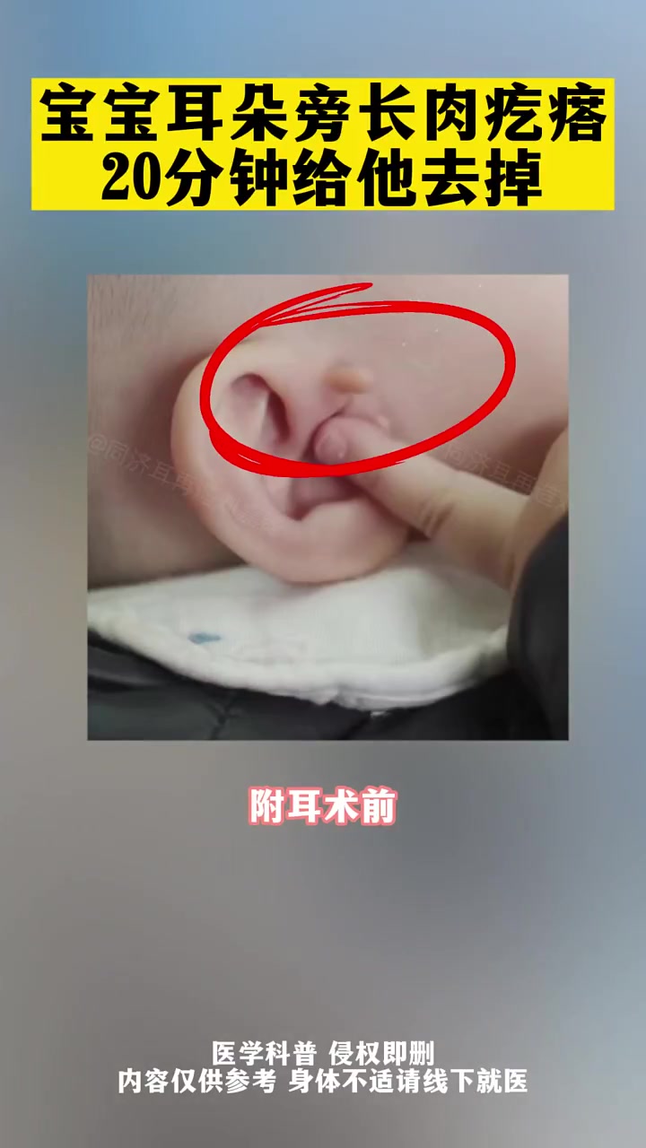 第45集|宝宝耳朵旁长肉疙瘩,20分钟给他去掉。附耳 耳朵