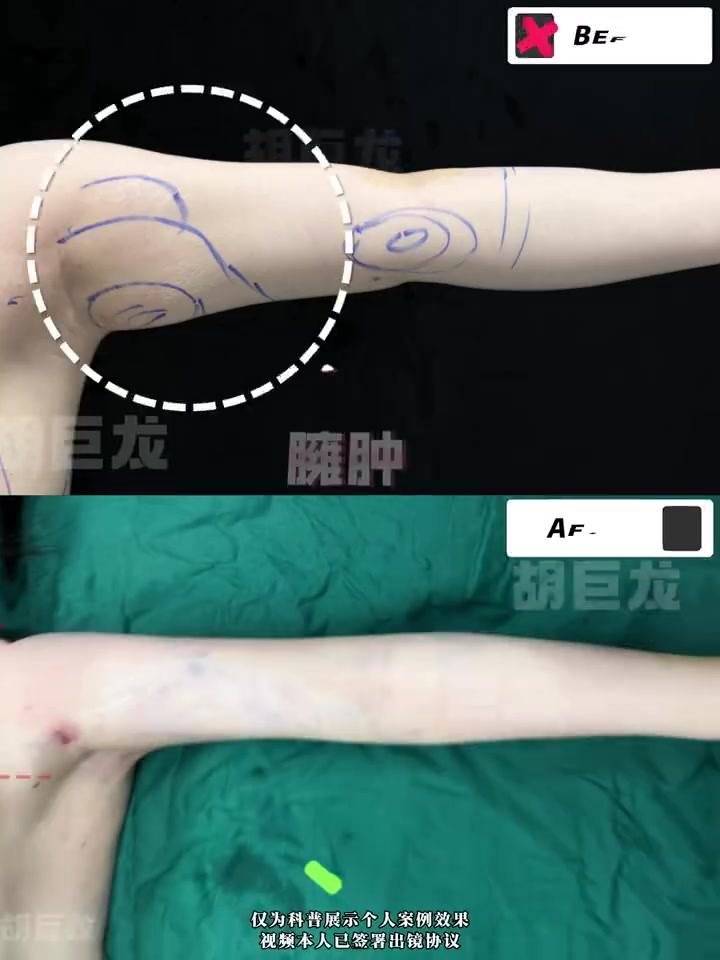 “瘦手臂真的不难,但想瘦且直需要考虑这些!”  手臂吸脂不像腰腹部吸脂,吸得越多越好,手臂