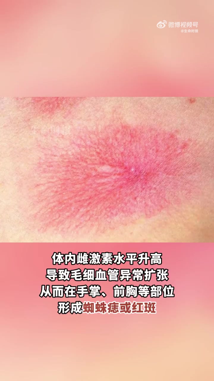手掌突然出现片状红斑,尤其是大小鱼际区域,按压后褪色,松开后恢复。这种“肝掌”可能与肝脏功
