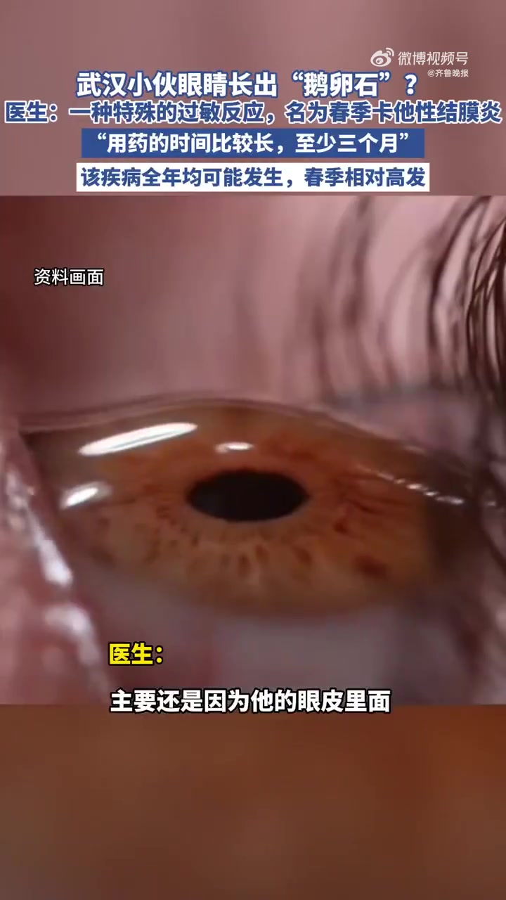 「小伙花粉过敏眼睛长出鹅卵石样增生医生提醒眼痒眼红别乱用药!」春暖花开花粉过敏也悄然来袭。