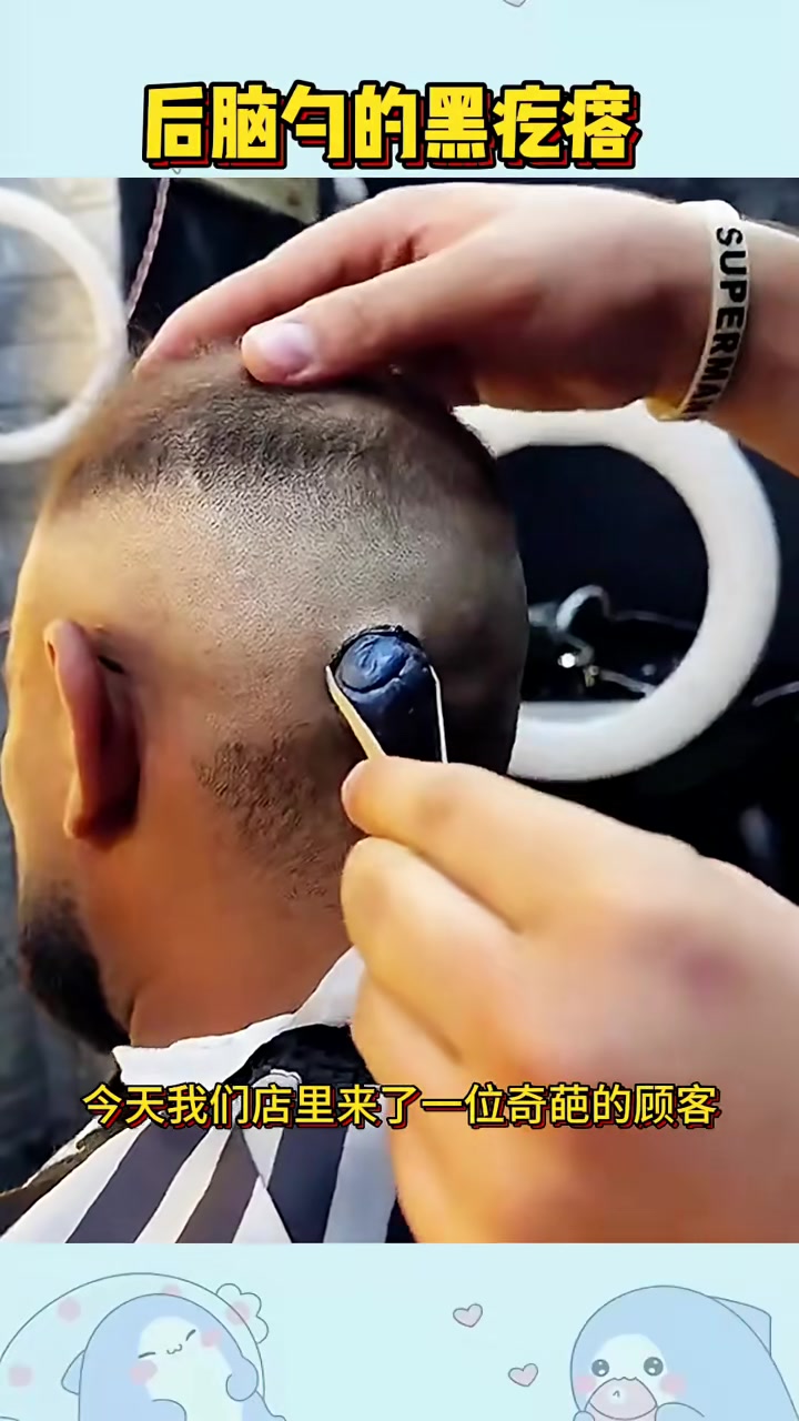 后脑勺的黑疙瘩,居然是个假的