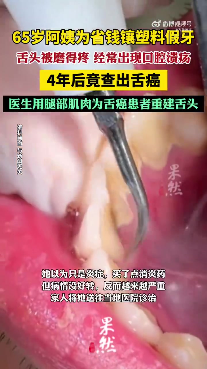 「舌头被磨得疼经常出现口腔溃疡,65岁阿姨镶塑料假牙4年后查出舌癌」医生用腿部肌肉给舌癌患