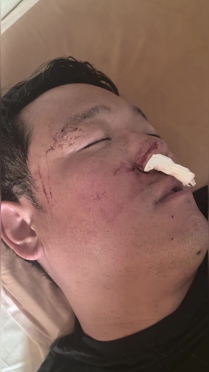 4月的北京,真是太恐怖了!今天早起吓了我一跳,孩子他爸满脸是血地躺在我身边,鼻子里还塞着一