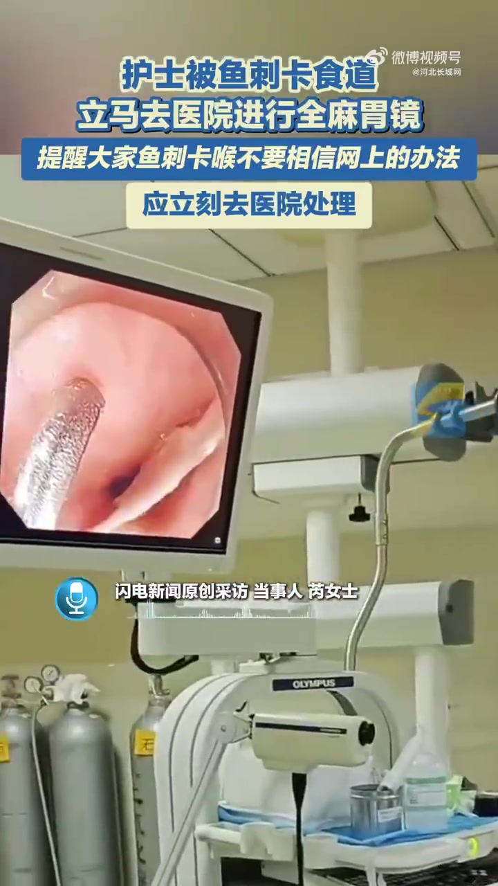 4月16日。安徽滁州。护士被鱼刺卡喉,立马去医院进行全麻胃镜,提醒大家鱼刺卡喉不要相信网上