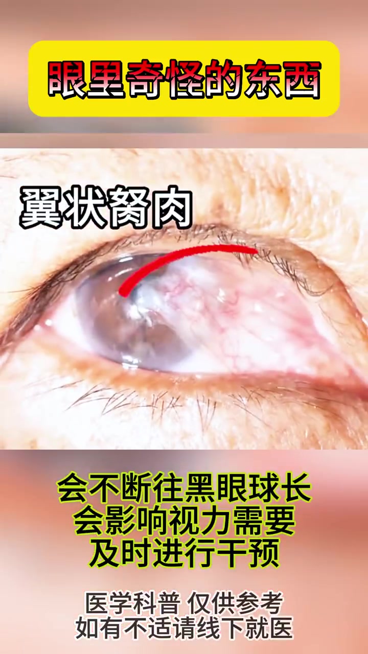 眼睛难受,有斑点到底要不要干预治疗