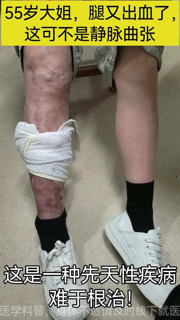 KTS先天性静脉畸形骨肥大综合征是难治先天性疾病,非下肢静脉曲张建议早治疗