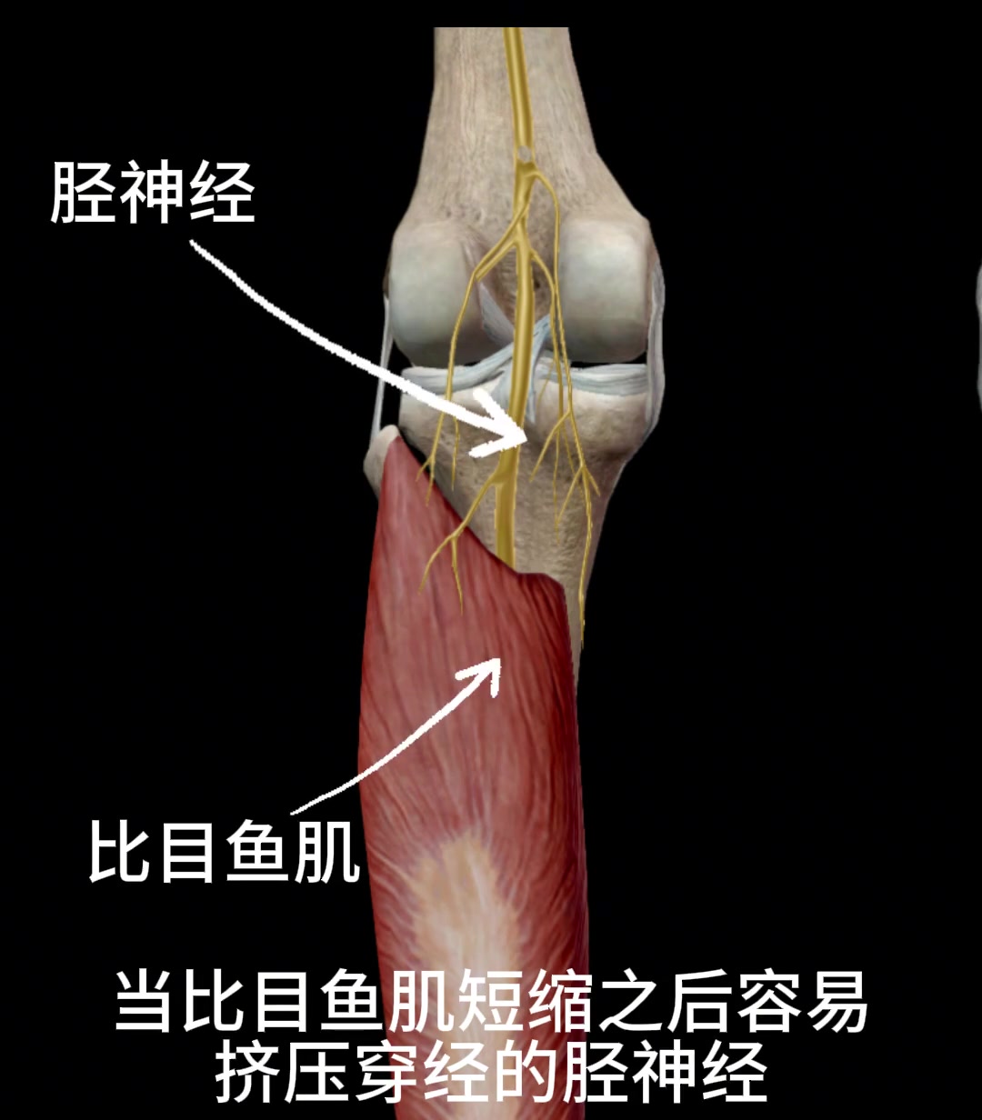 胫神经卡压科普介绍