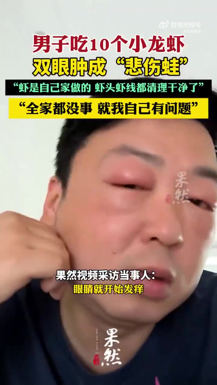 「男子吃10个小龙虾双眼肿成悲伤蛙:全家人都吃了,就我一个人有问题」近日,江苏一男子发视频