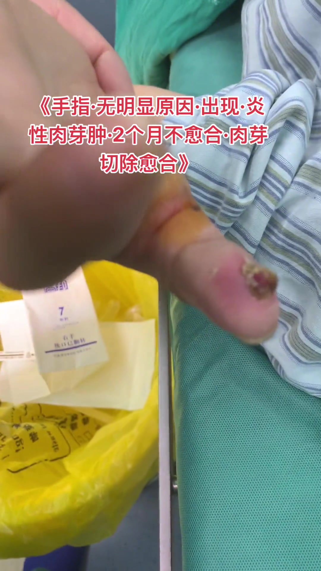 炎症肉芽肿久不愈合易出血，轻度可换药，大的慢性肉芽肿需切除