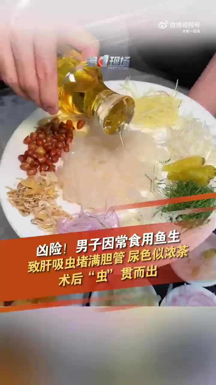 「尿色似浓茶,术后“虫”贯而出!「惊哭」广东一男子常吃鱼生导致胆管长满肝吸虫」前段时间,广