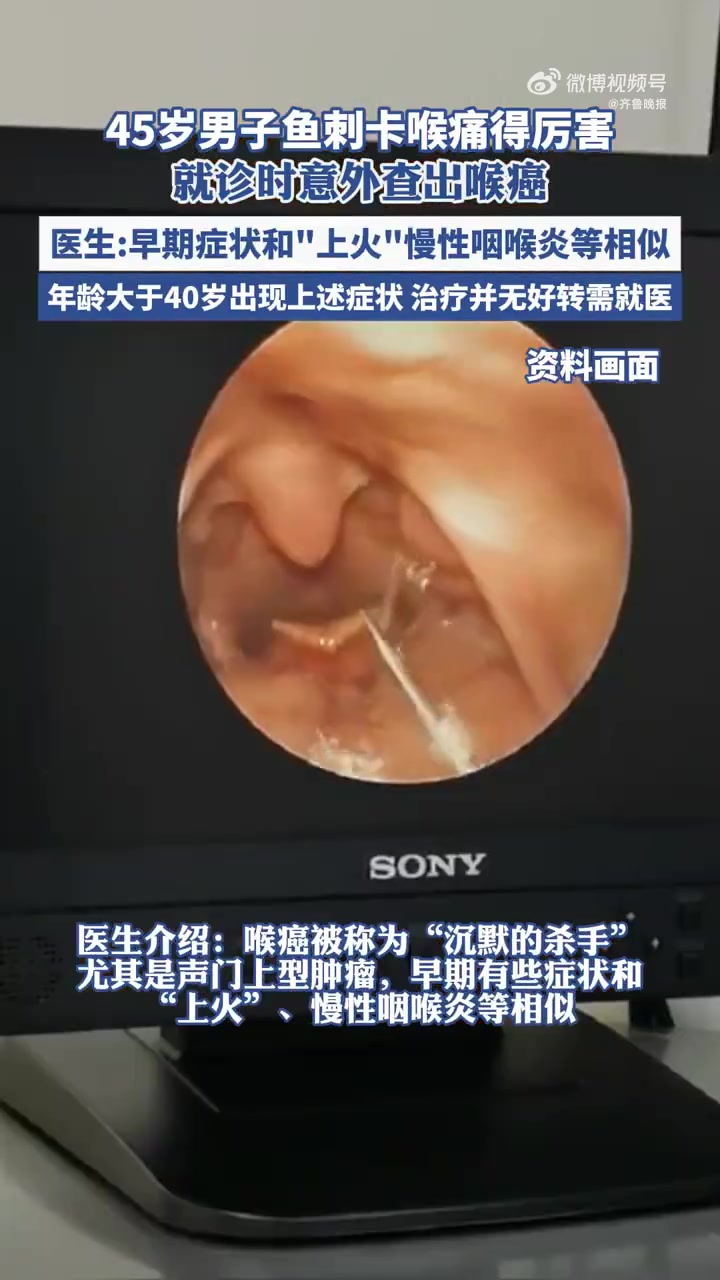 近日,浙江宁波。45岁的陈先生因中午吃鱼卡了刺,喉咙痛得厉害就医。医生在间接喉镜下没有发现