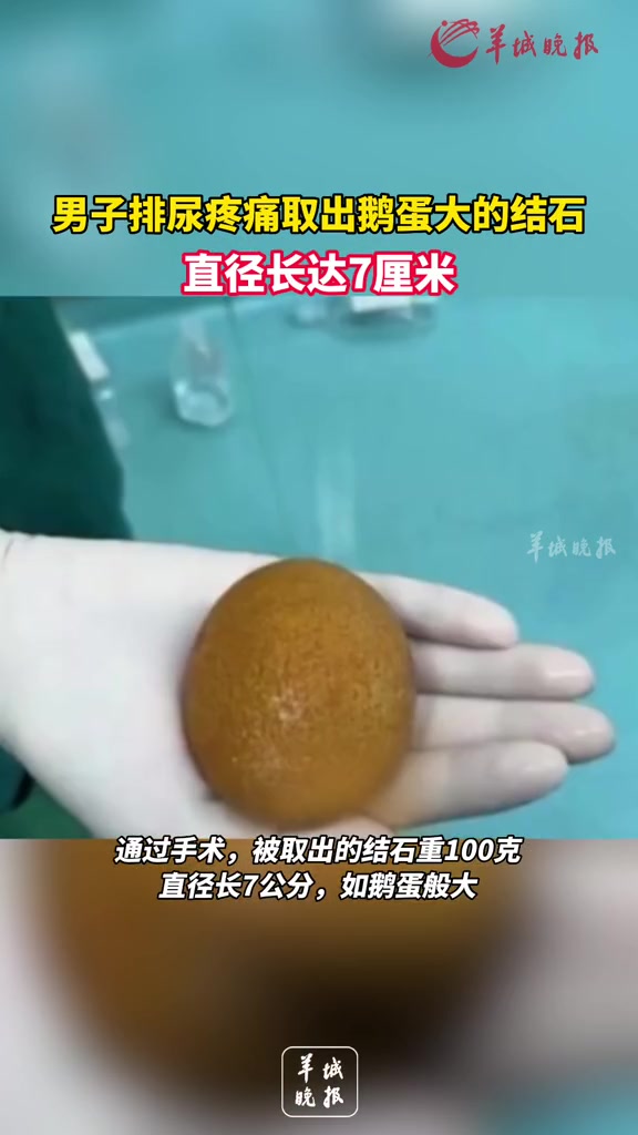 男子排尿疼痛取出直径7厘米鹅蛋大结石