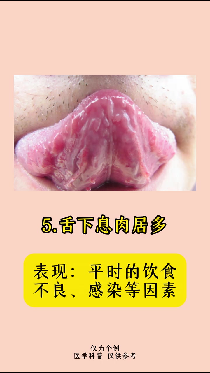 舌下是看人体淤血最明显的地方，对照一下你的舌下