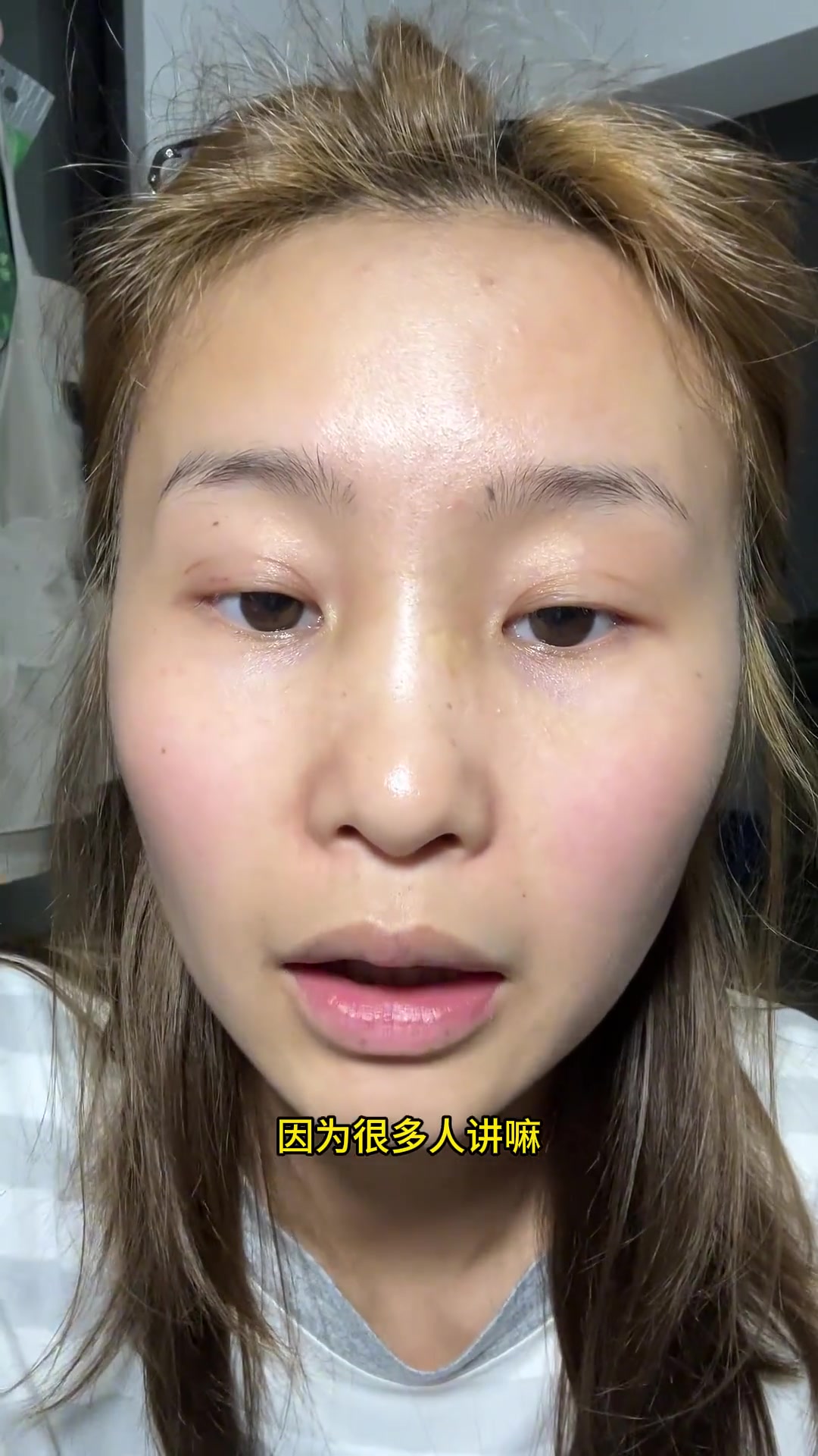 双眼皮埋线手术,15天恢复过程全记录,自然双眼皮效果展示