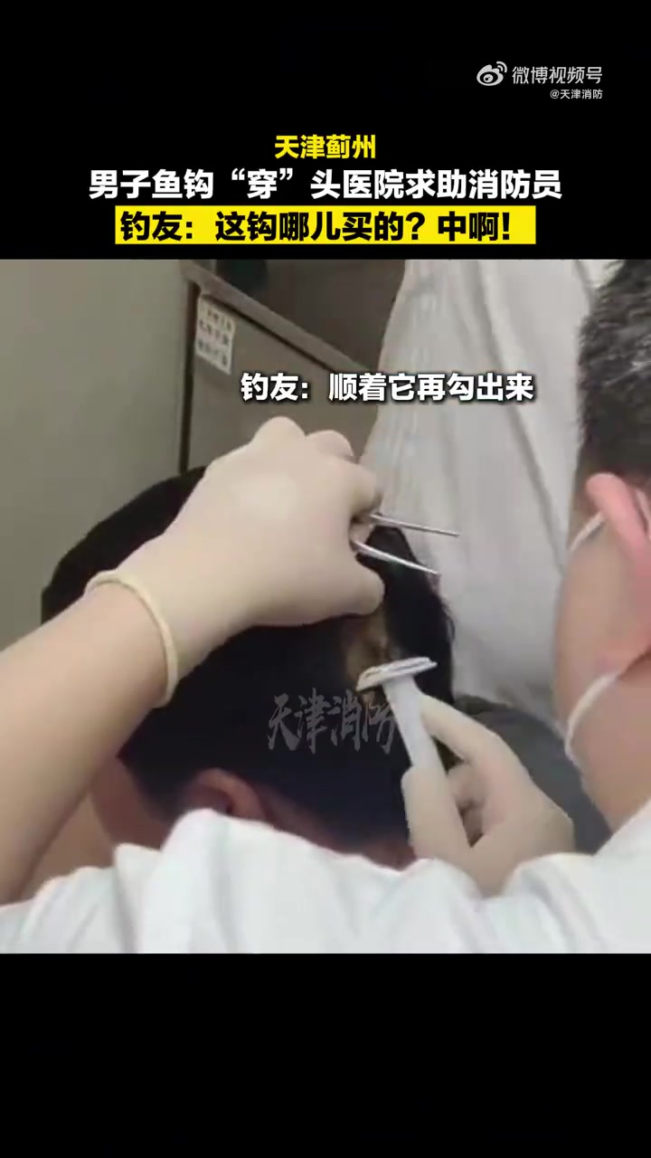 天津蓟州区,男子钓鱼时不慎被鱼钩勾住头皮,三个钩两个扎入了皮肤,男子紧急前往医院。医生“摇