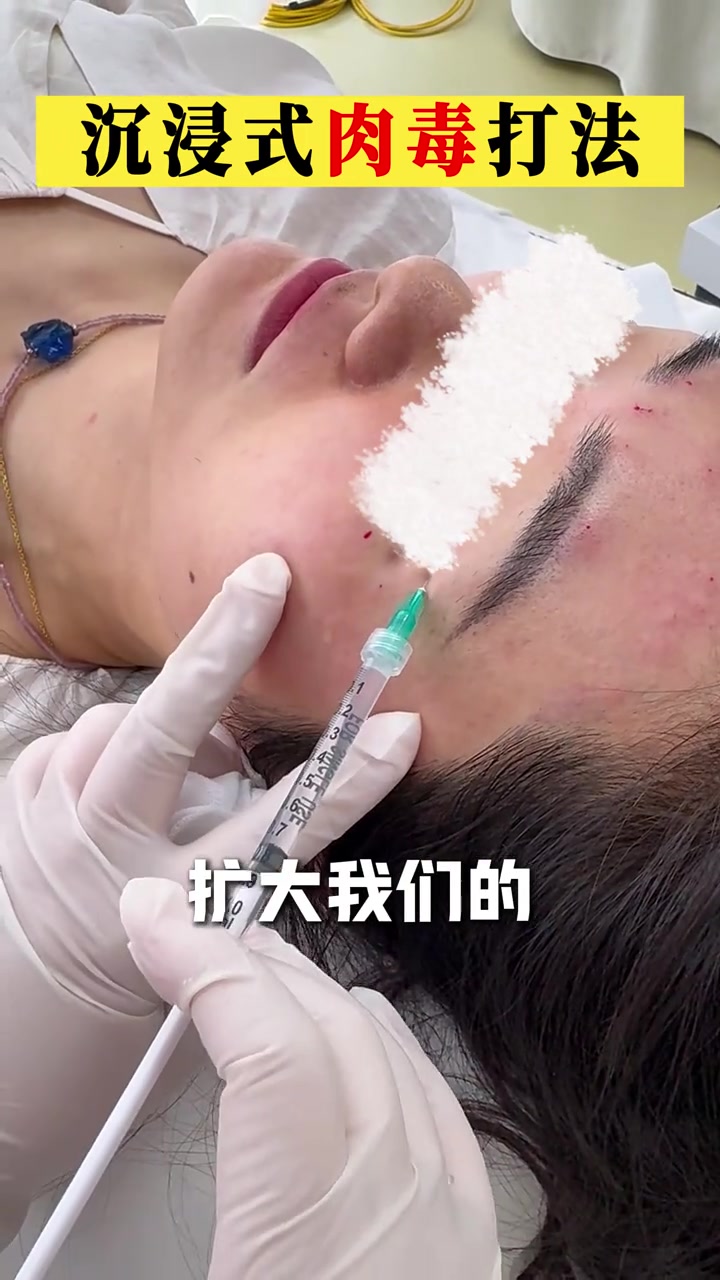打肉毒素的点位设计及注射部位疑问