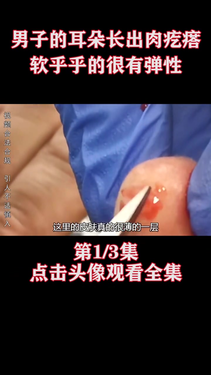 男子耳朵长出软乎乎有弹性肉疙瘩,医生破开疙瘩开盲盒