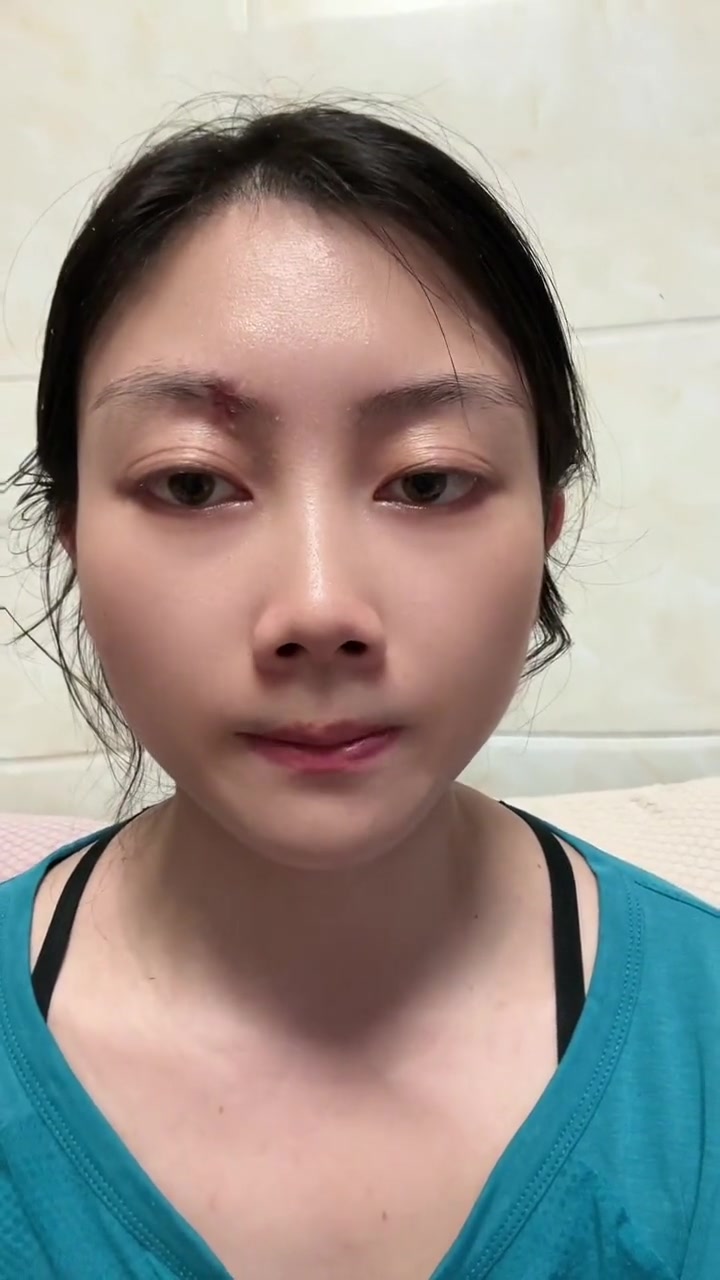 切痣拆线第一天恢复良好，切生长毛发肉痣的两个重点建议