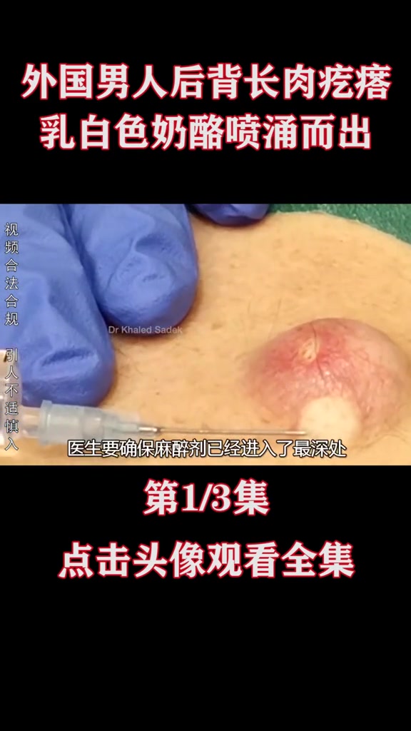 外国男人后背长疙瘩，医生扎开后奶酪状物质喷涌而出