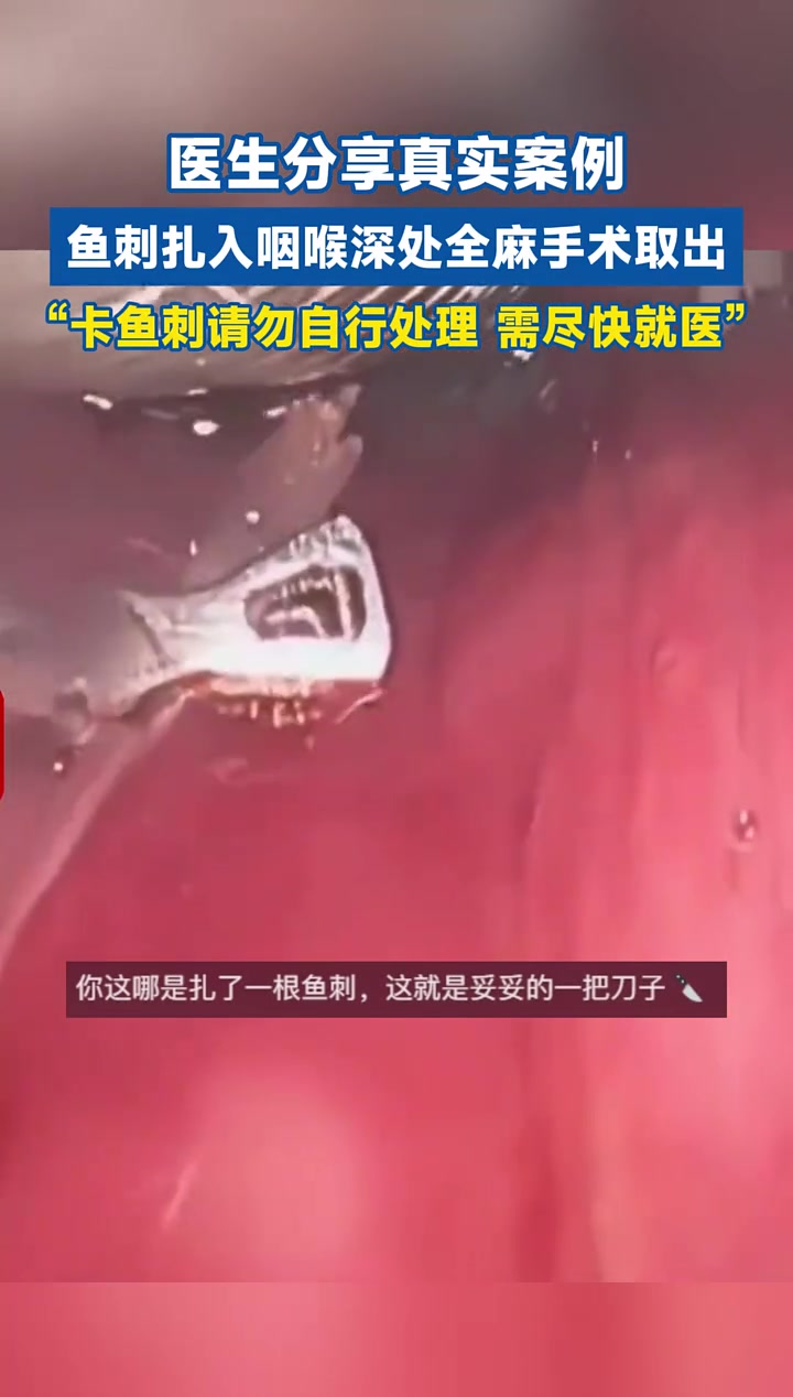 医生分享真实案例,鱼刺扎入咽喉深处全麻手术取出,“卡鱼刺请勿自行处理,需尽快就医”