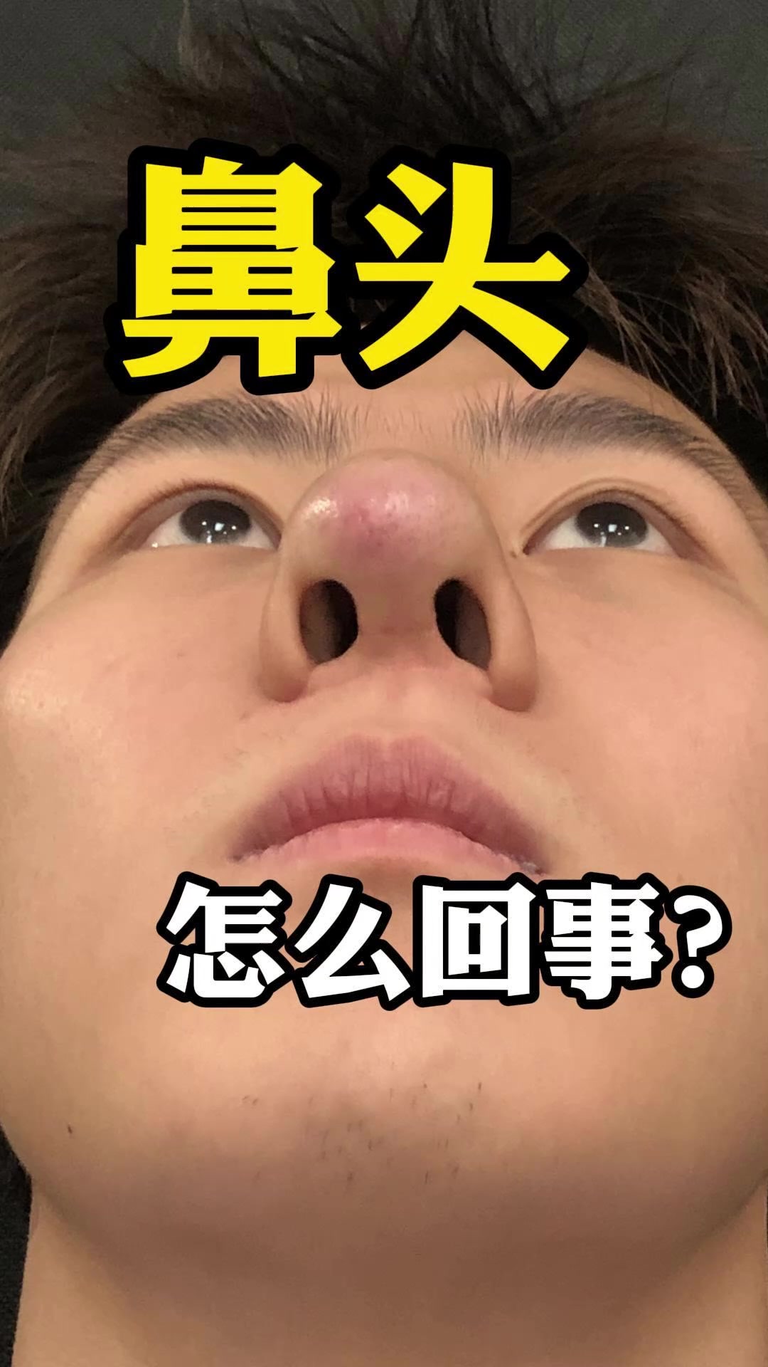 鼻头红肿的三个原因？早期症状不要忽视！