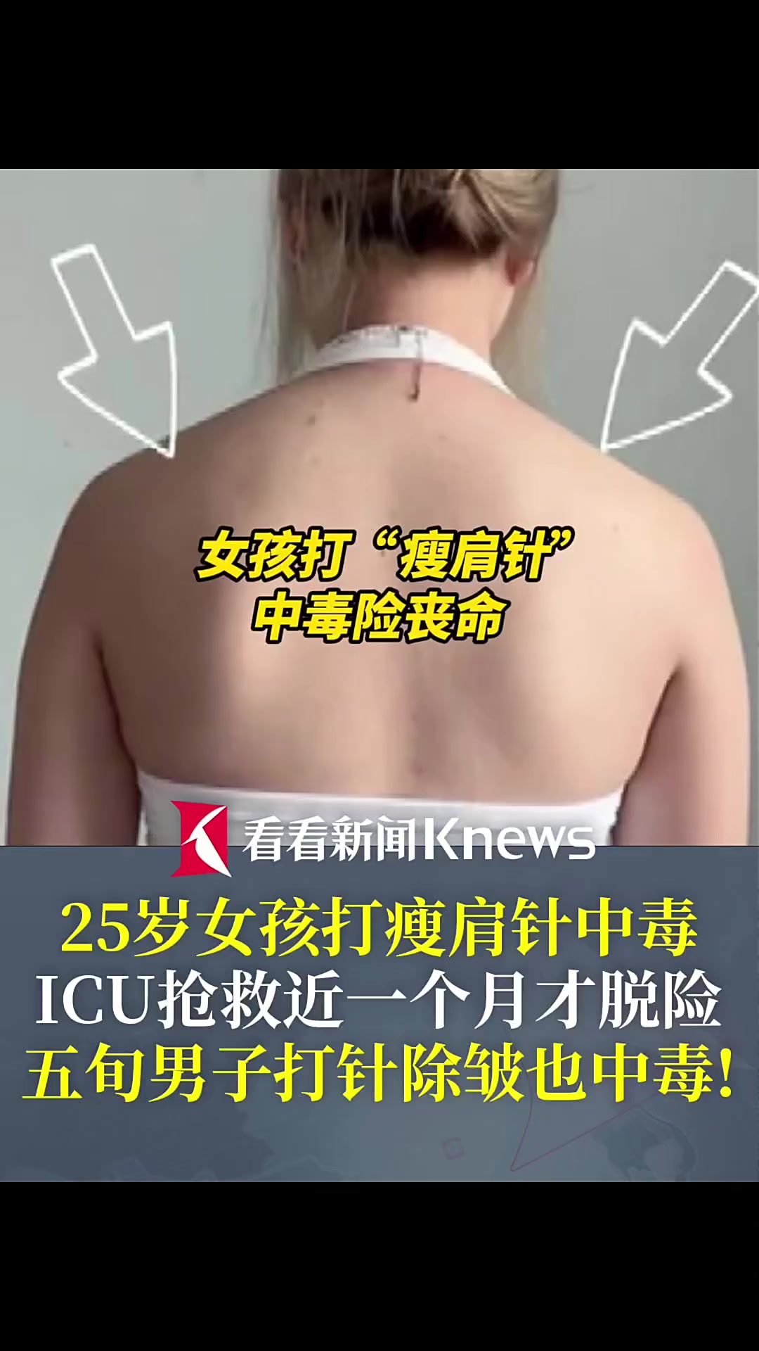 25岁女孩打肉毒素中毒 ICU抢救近一个月才脱险