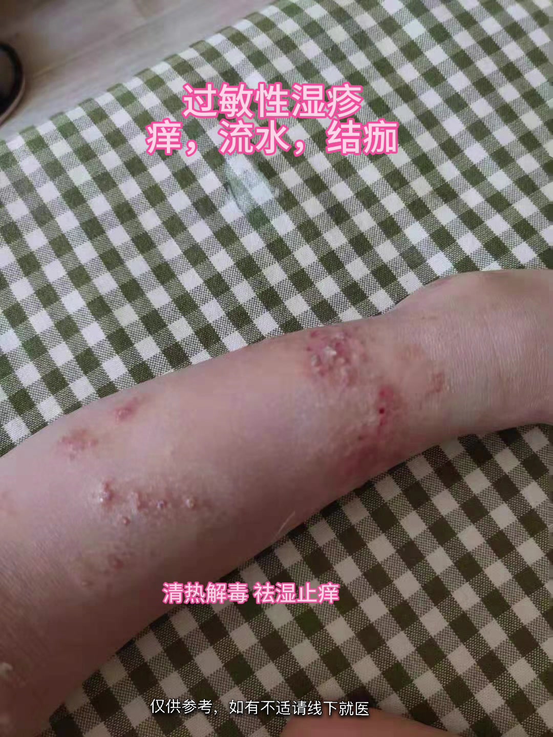 过敏性湿疹,痒,出水,结痂,清热解毒
