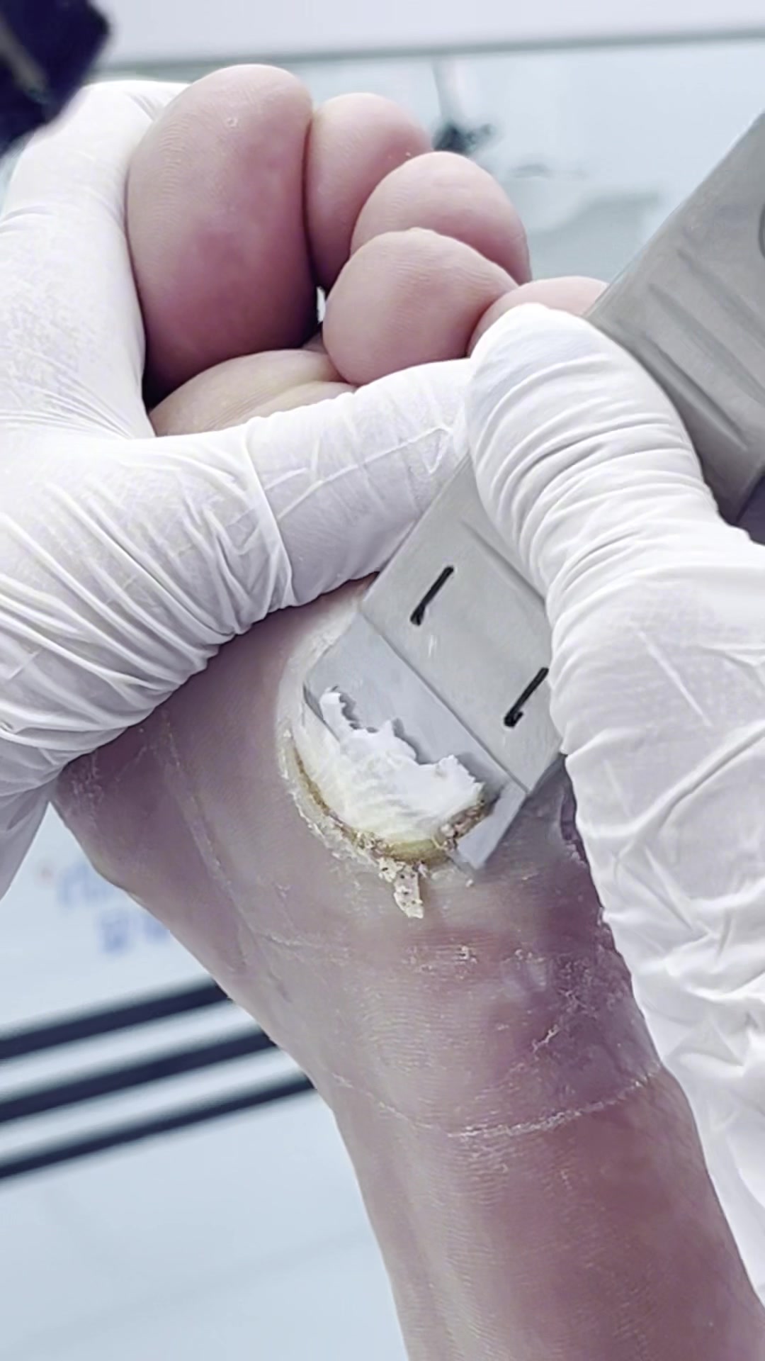 脚底有个大肉丁走路扎的不舒服,去百货大楼南200米路西孙氏护足