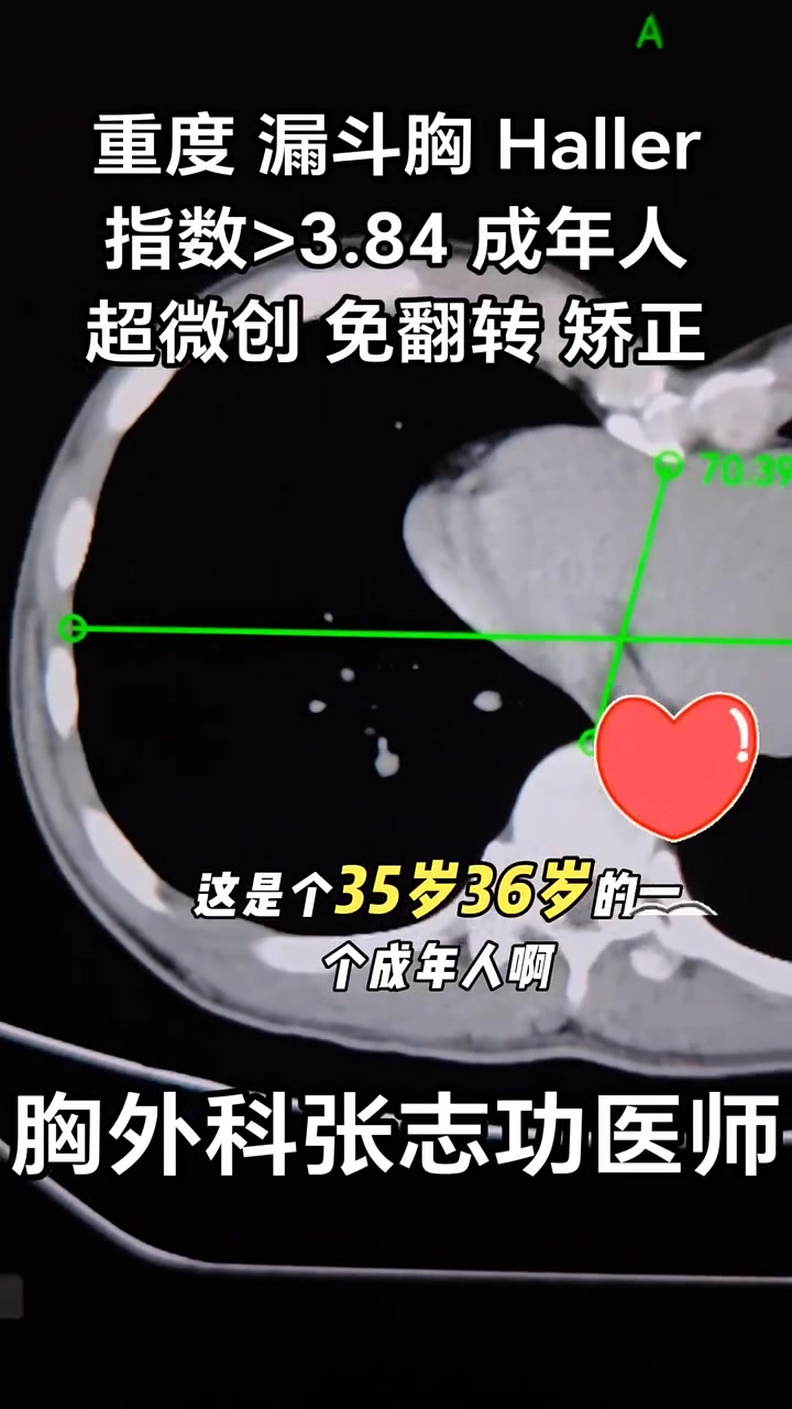 重度 漏斗胸 Haller指数>3.84 成年人