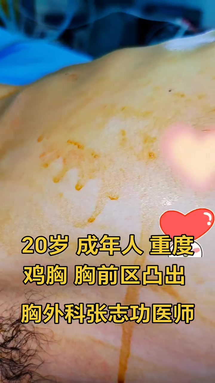 20岁 成年人 重度 鸡胸 胸前区凸出