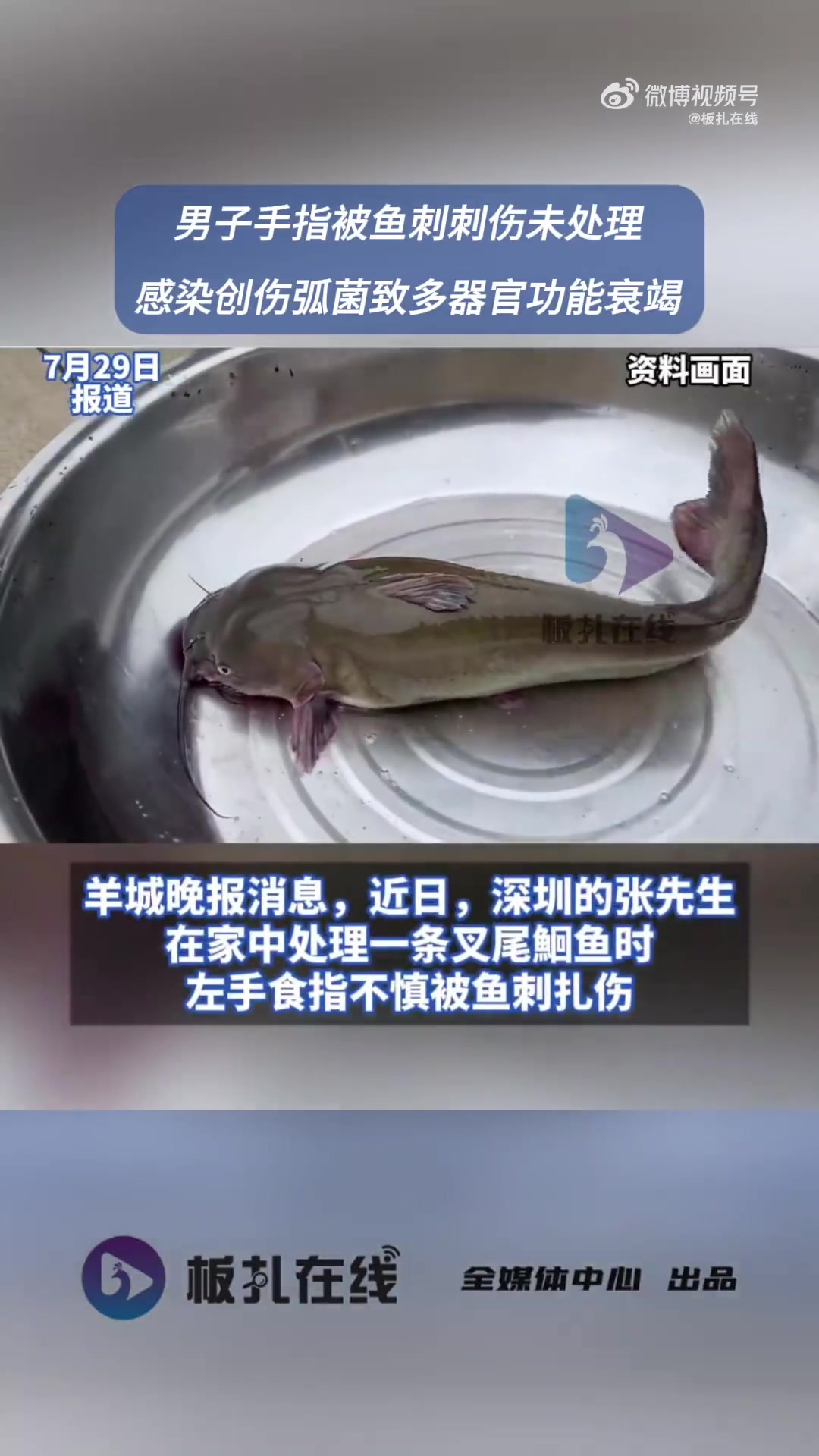 7月28日,广东深圳。张先生在家中处理一条购买回来的叉尾鮰鱼时,左手食指不小心被鱼刺刺伤。
