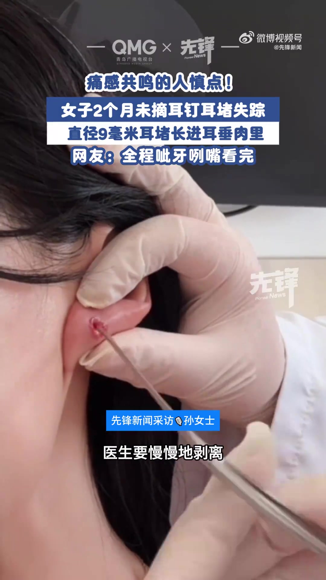 近日,江苏南京。女子近2个月未摘耳钉,直径9mm黄金耳堵长进肉里!医生诊断耳堵已经在耳垂内
