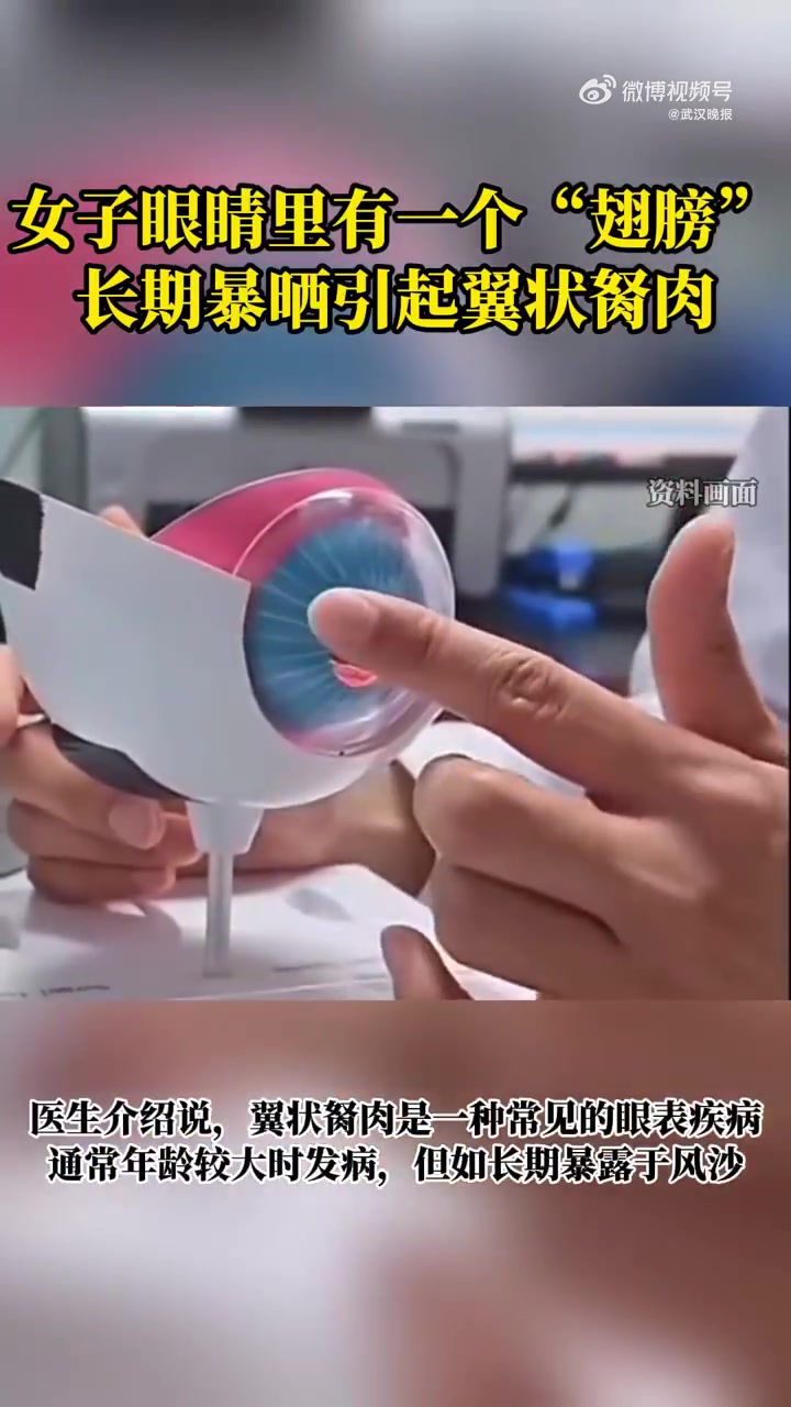 近日,湖北武汉。38岁的陈女士长期在户外工作,5年前发现左眼长出一小块红白色的“肉”,因为
