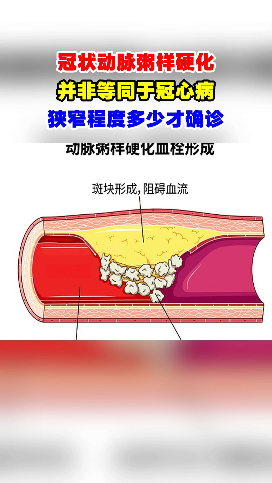 冠状动脉粥样硬化,并非等同于冠心病,狭窄程度多少才确诊