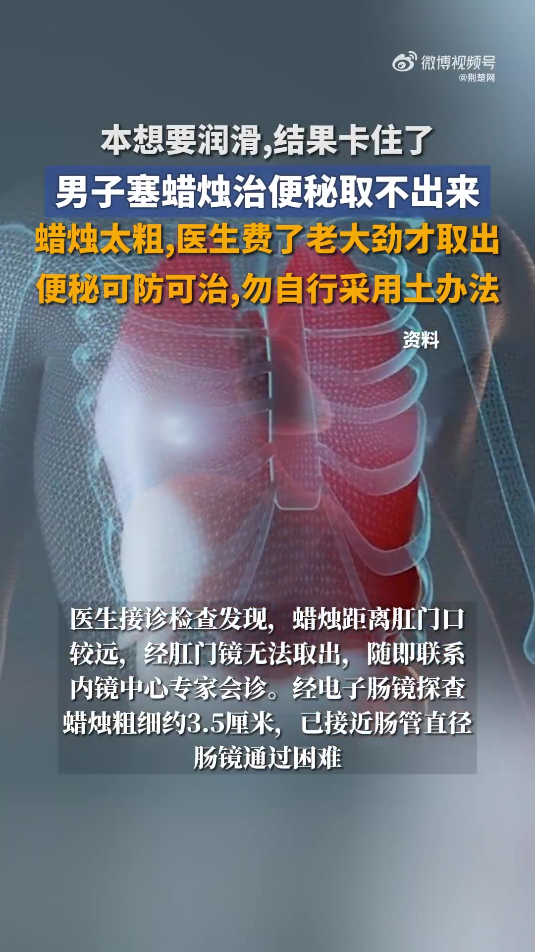「男子塞蜡烛治便秘取不出来,蜡烛太粗,医生费了老大劲取出」近日,一名男子在妻子搀扶下,满脸