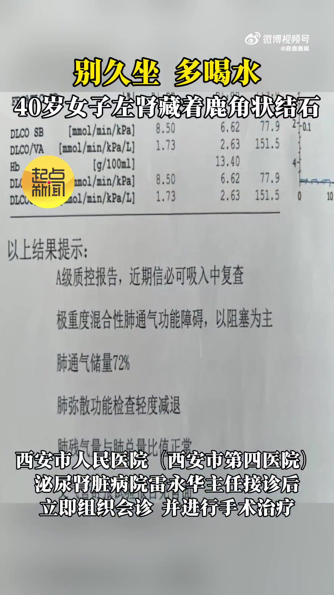 「别久坐、多喝水 女子左肾长一颗鸡蛋大小鹿角状结石」近日,陕西西安。40岁的张女士(化名)